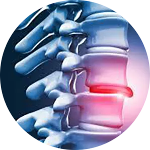 Disc Injury Treatment Near Me in Newark, DE. Chiropractor For Disc Injury Pain Relief.